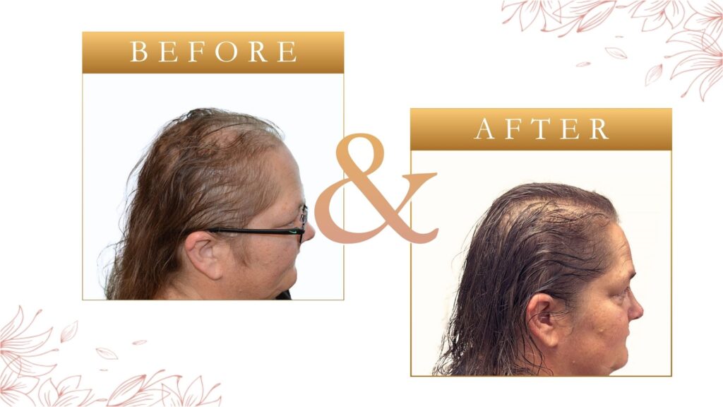 Hair Loss Treatment For Women St Petersburg FL