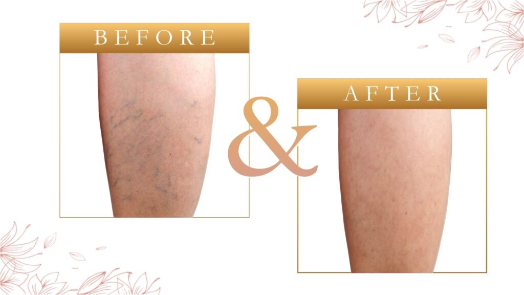 Spider Vein Removal St Petersburg FL