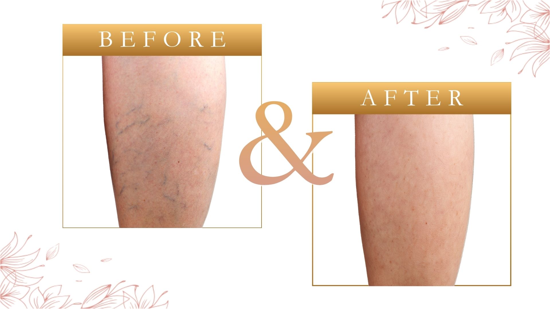 Spider Vein Removal St Petersburg FL