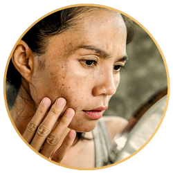 Skin Tone Correction for Melasma Treatment St Petersburg FL
