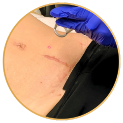 St Petersburg Laser Scar Removal