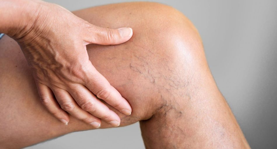 St Petersburg Vein Treatment